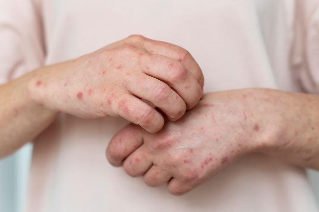 Атопический дерматит с очаговой лихенификацией кожного покрова: симптомы, причины и лечение - исследование