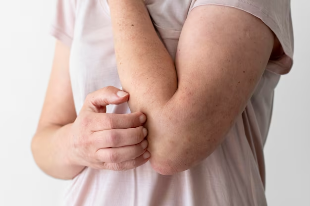 Симптомы и лечение атопического дерматита у взрослых - полезная информация